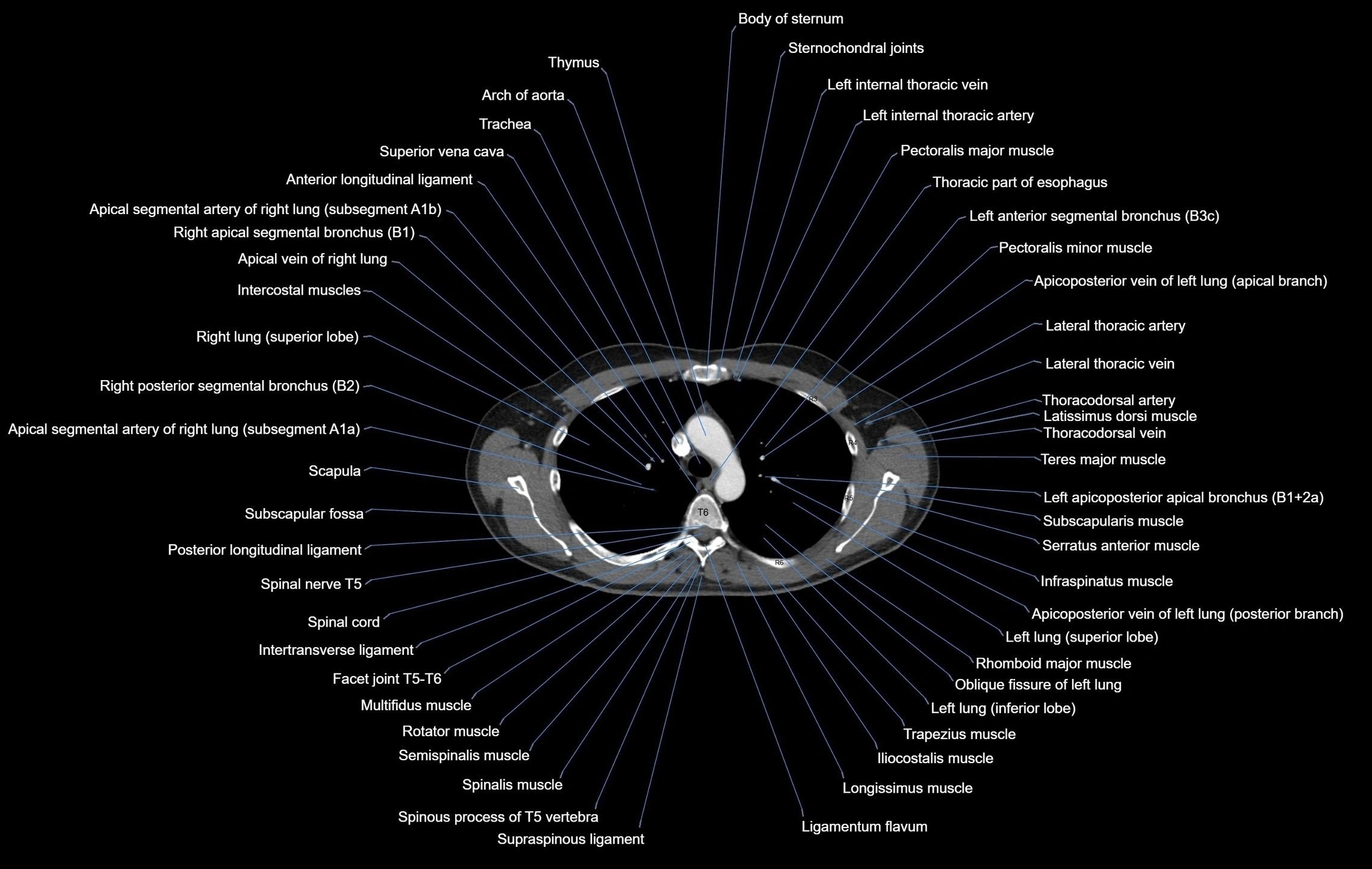 CT chest (thorax) labelled axial cross sectional anatomy radiology image-00040.webp